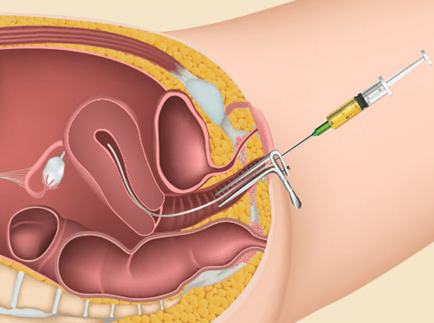Fresh Embryo Transfer in Bangalore