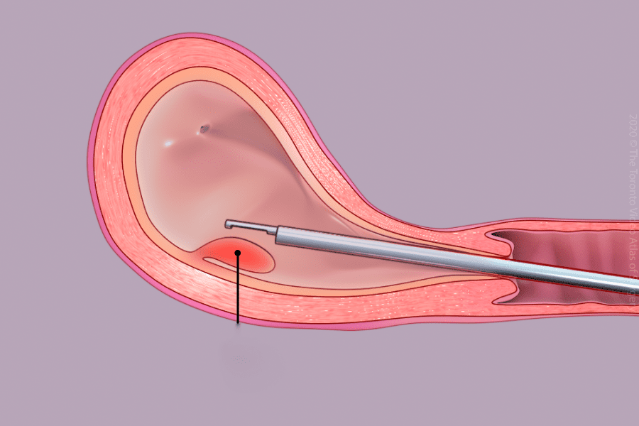 Hysteroscopy Treatment in Bangalore